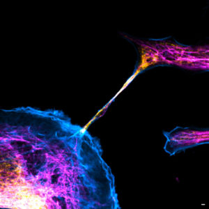 Image of a cellular interconnection between two human tumor cells whose cytoskeleton has been labeled with anti-tubulin, anti-vimentin antibodies and with Phalloidin probe. Imaged with confocal microscopy.