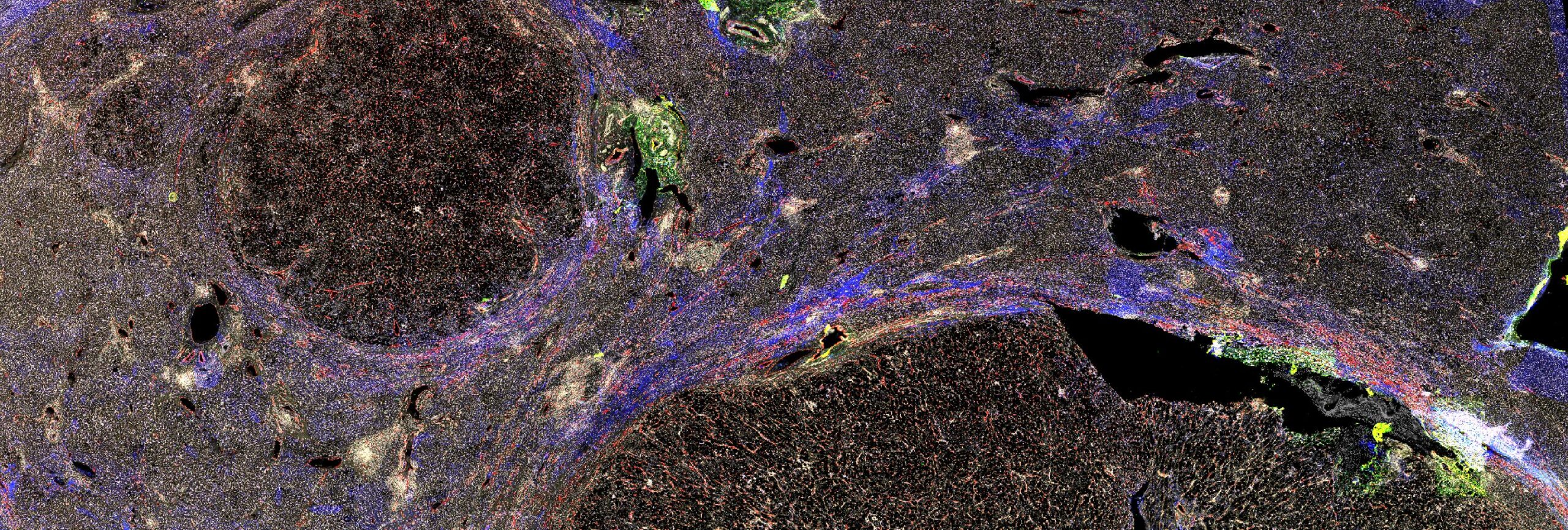 Mapping the immune landscape of human hepatocellular carcinoma with ...